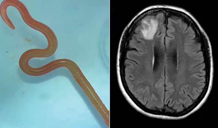 Surgical removal of a live worm from a woman’s brain